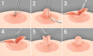 chirurgie mamelon ombilique